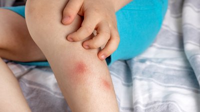 Child boy legs with mosquito bite big red spots