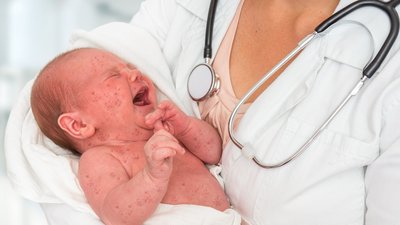 Doctor holding a newborn baby which is sick rubella or measles