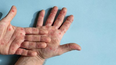 Male hands with Monkeypox rash