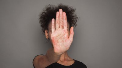 Stop Measles Virus. African Woman With Red Spots On Palm